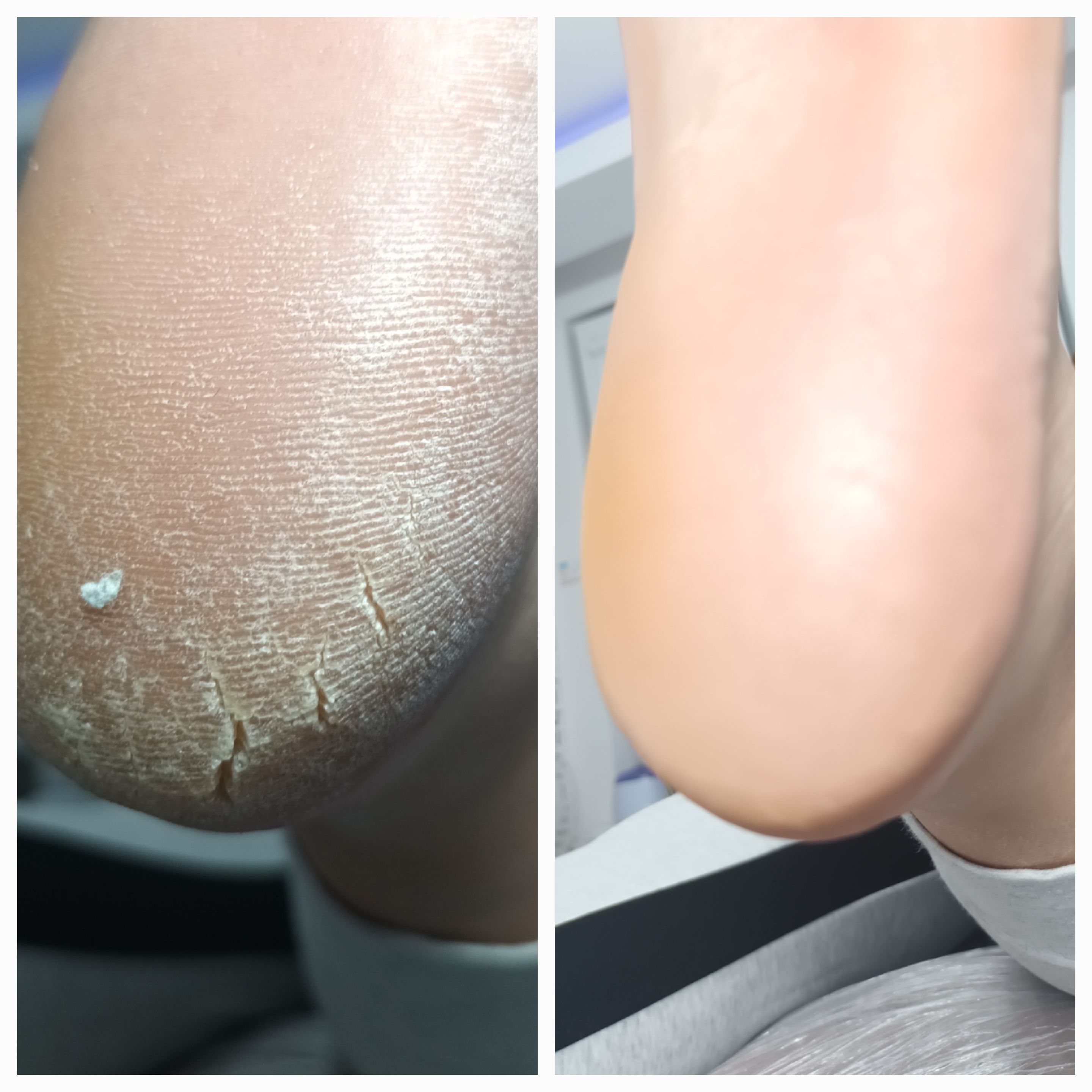 Pedicure leczniczy - zdjęcie 6