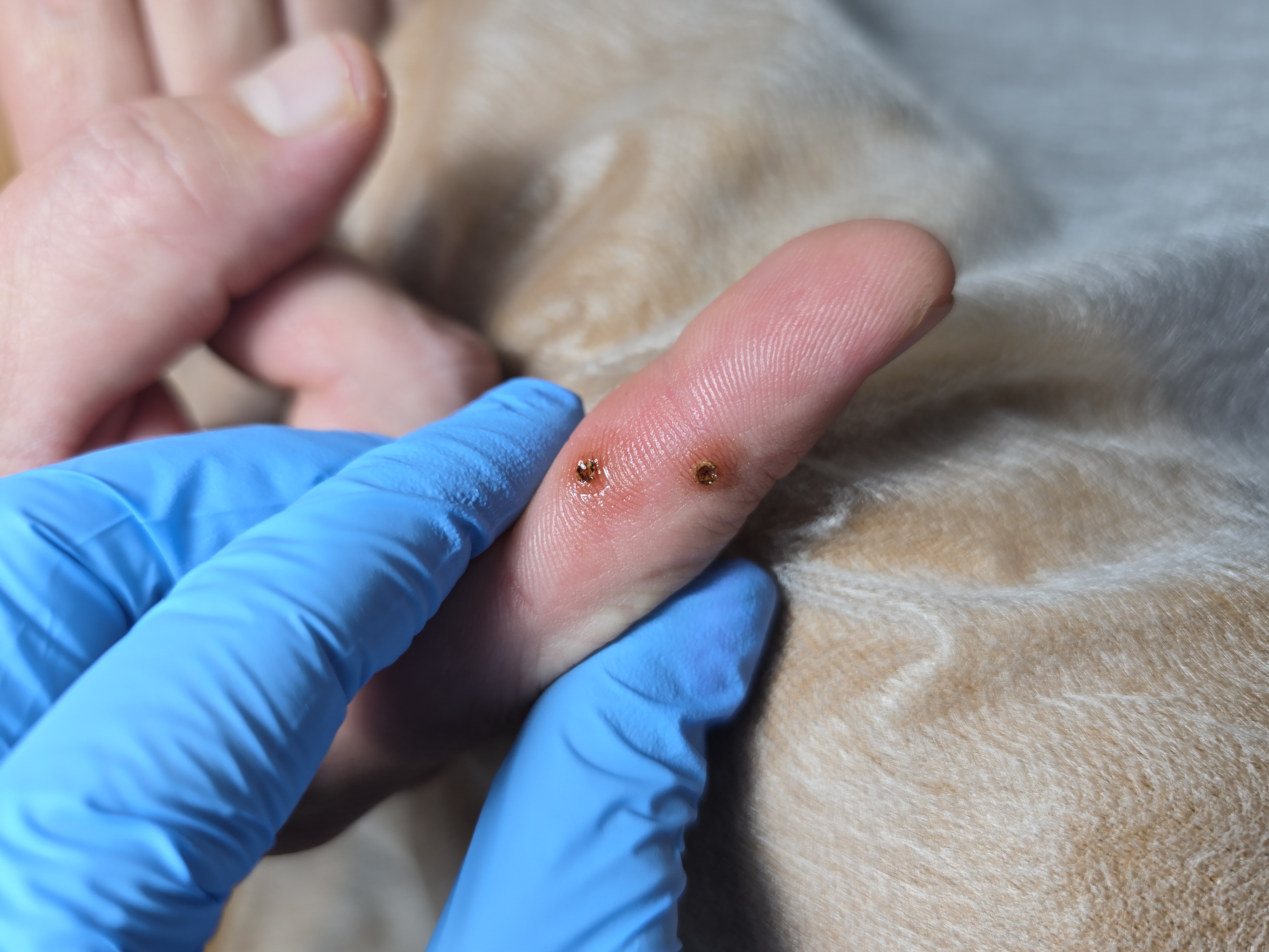 Usuwanie brodawek - zdjęcie 6