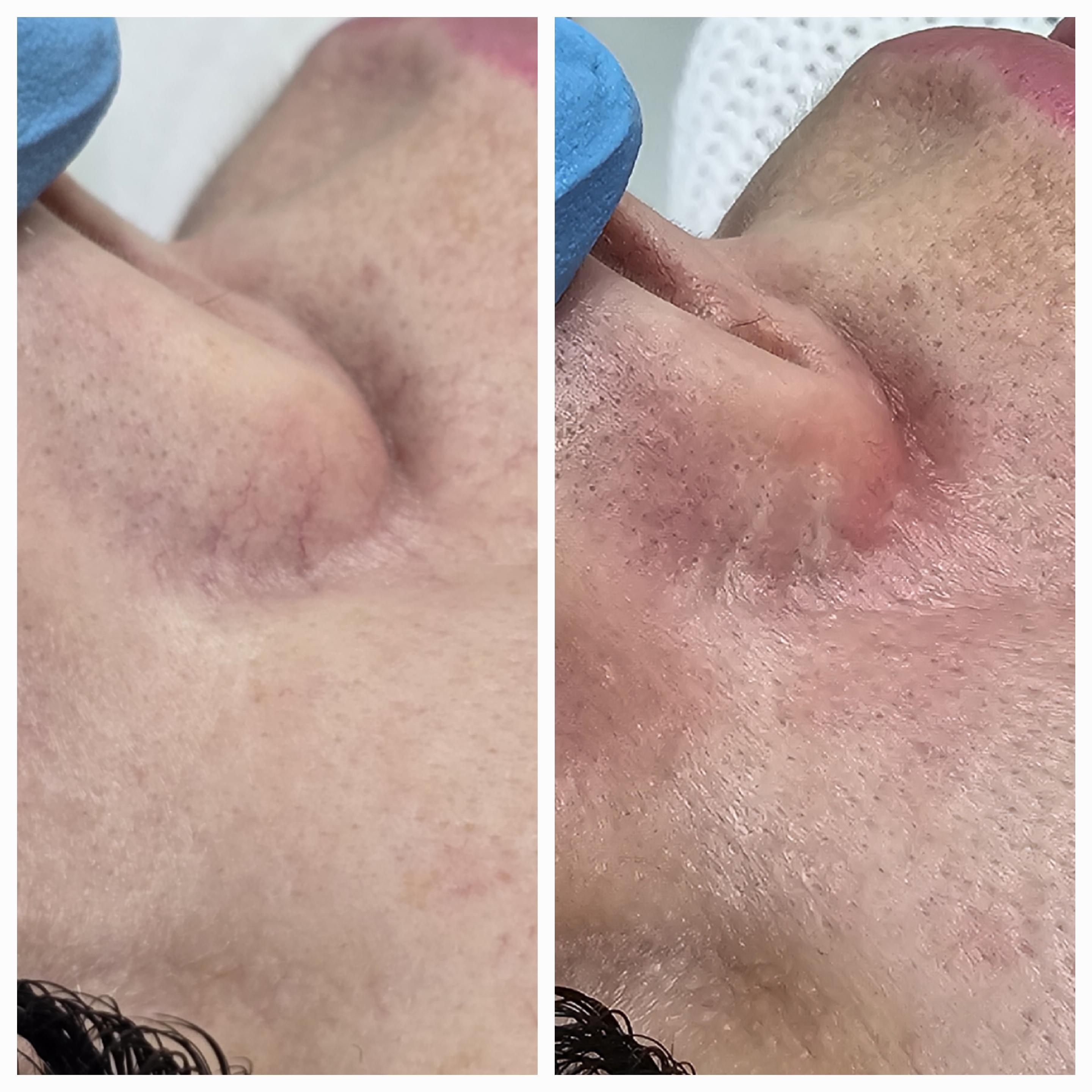 Zamykanie naczynek i usuwanie włókniaków - zdjęcie 6