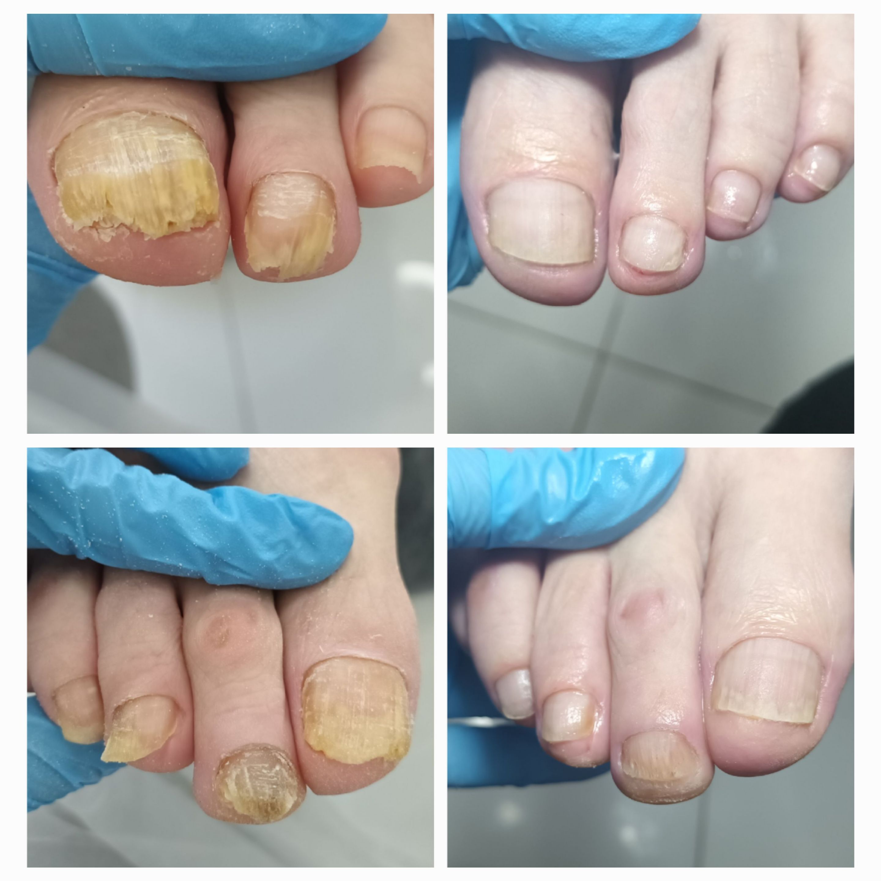 Choroby i defekty płytki paznokciowej - zdjęcie 7