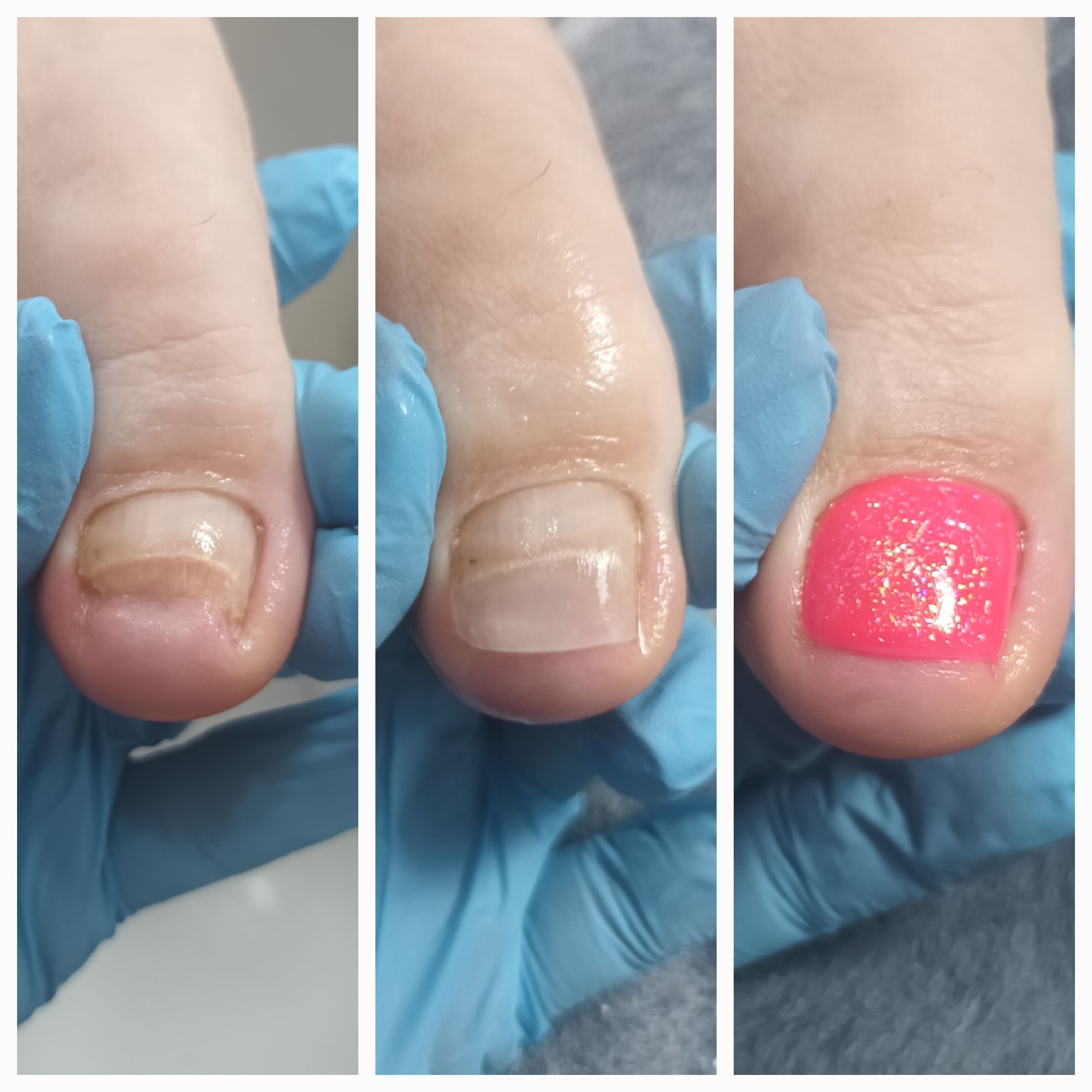 Klamry i rekonstrukcje podologiczne - zdjęcie 7