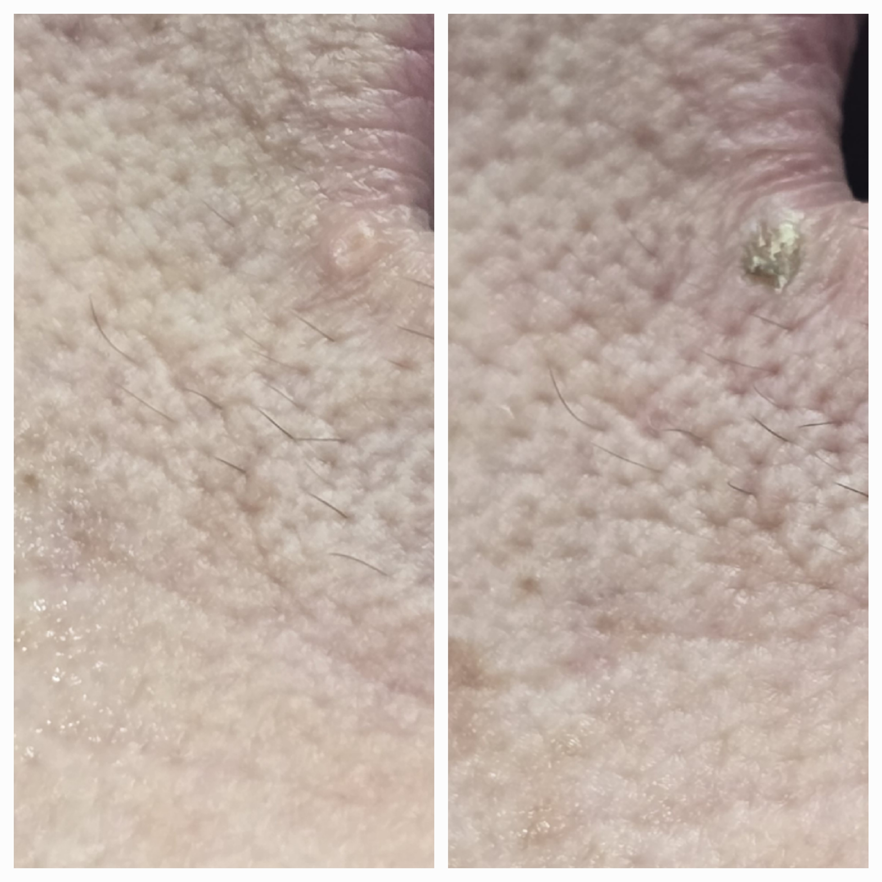 Zamykanie naczynek i usuwanie włókniaków - zdjęcie 7