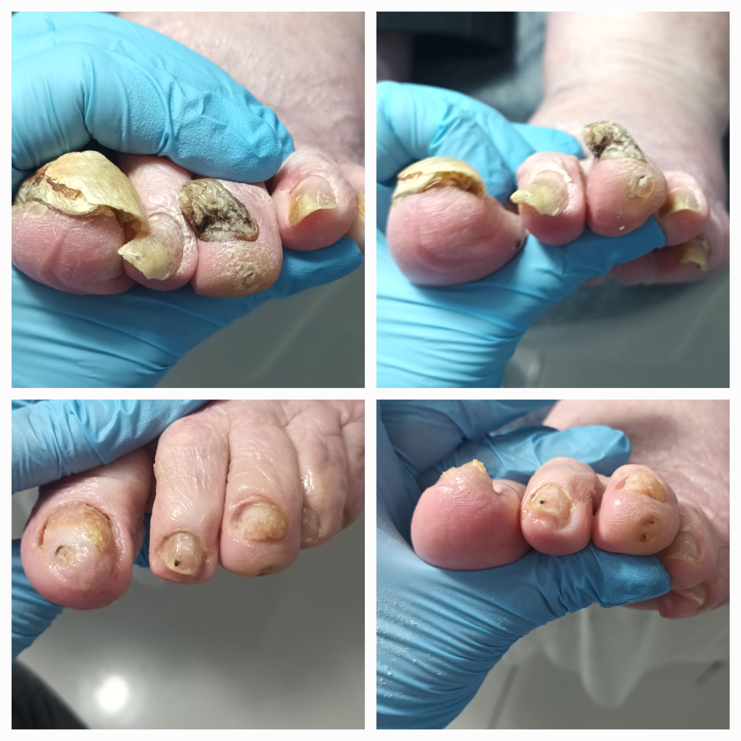 Choroby i defekty płytki paznokciowej - zdjęcie 8