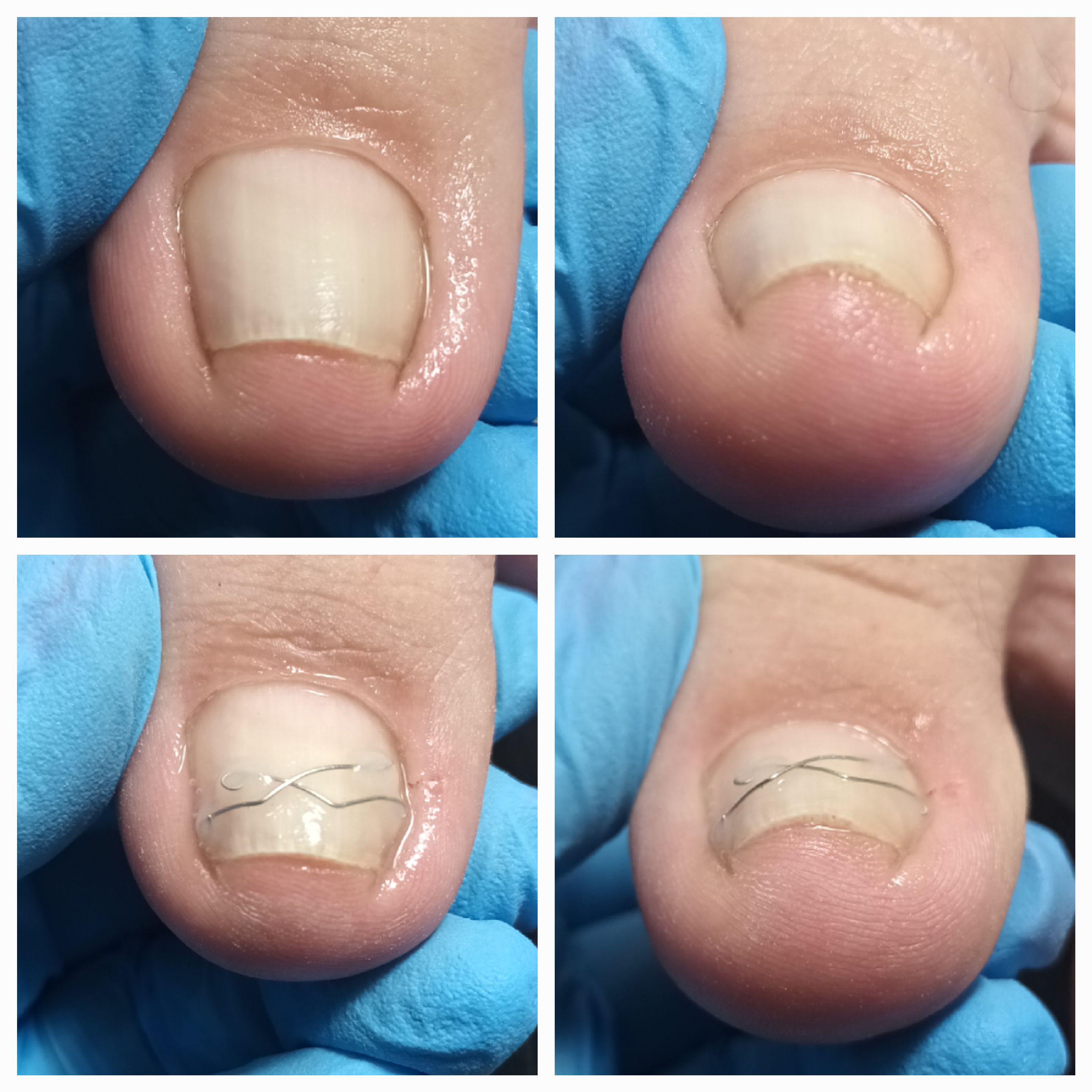 Klamry i rekonstrukcje podologiczne - zdjęcie 8