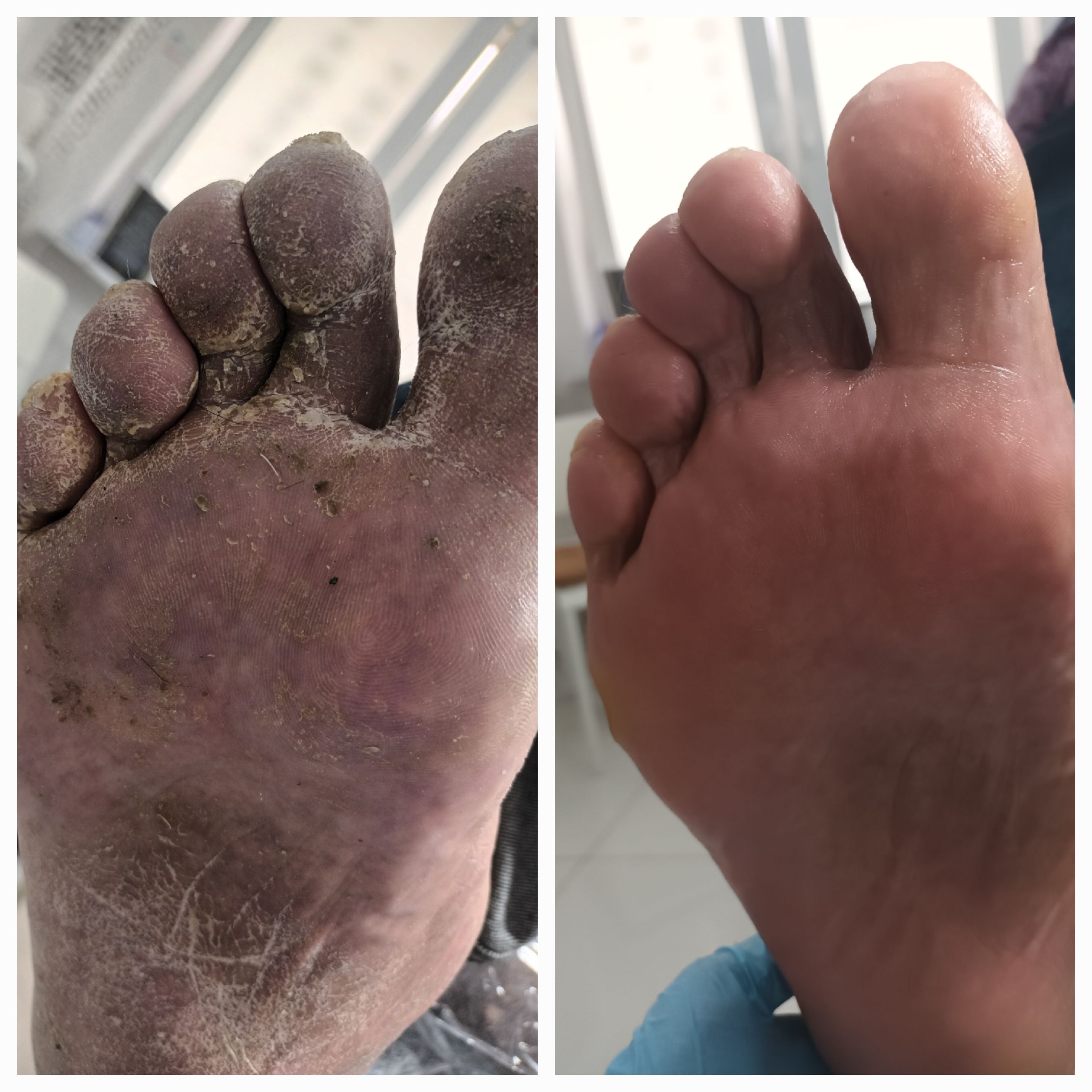 Pedicure leczniczy - zdjęcie 8