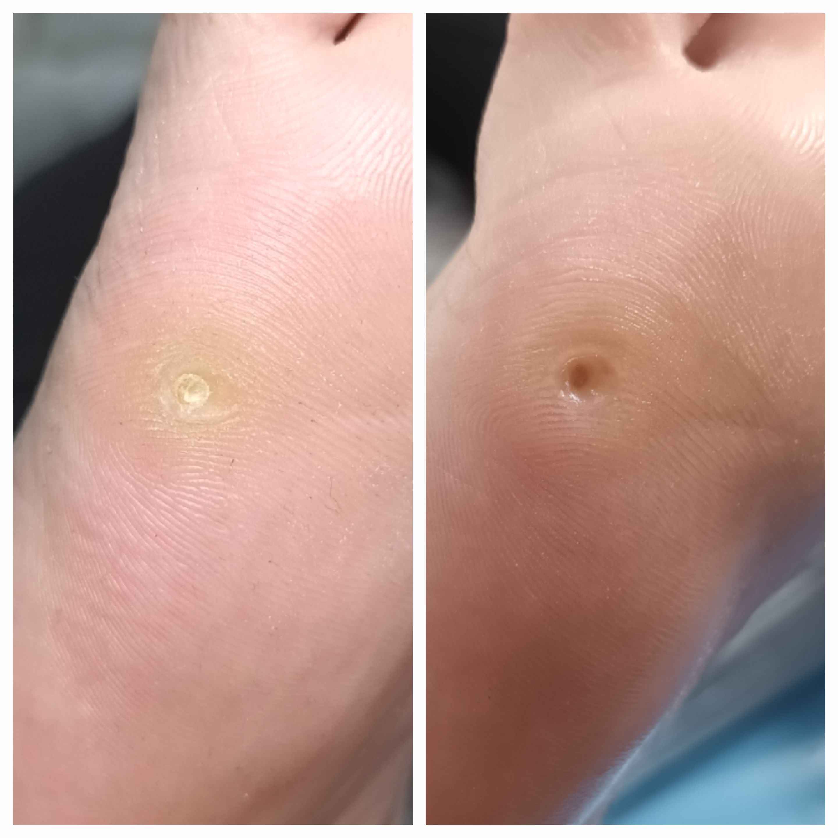 Usuwanie modzeli i odcisków - zdjęcie 8