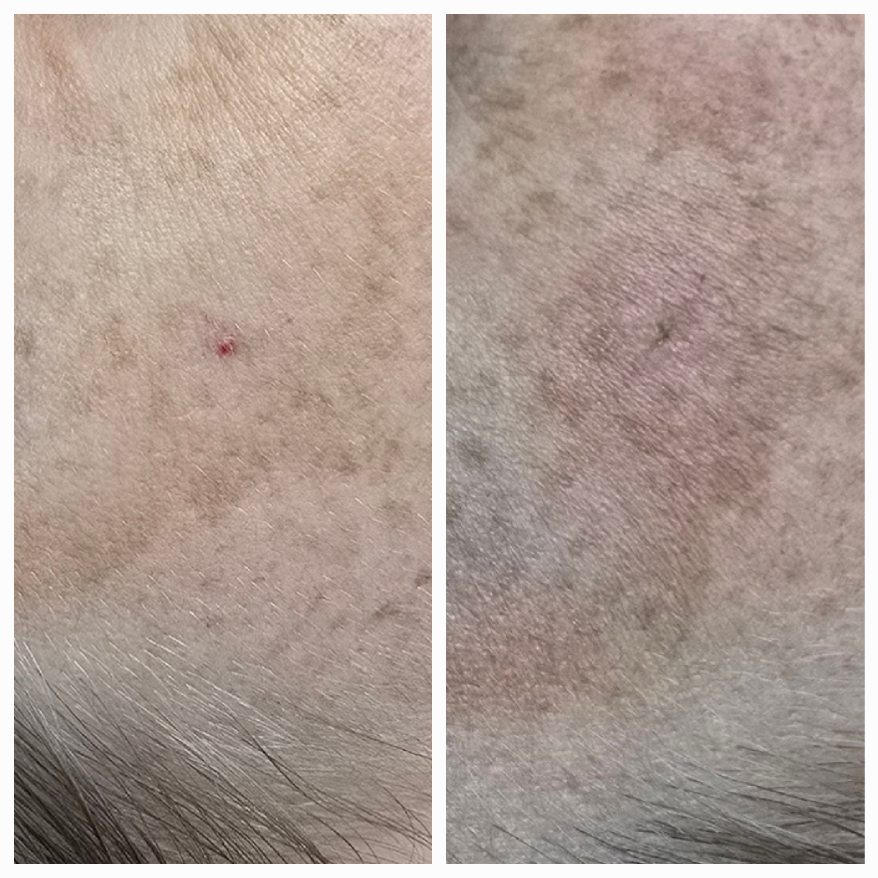 Zamykanie naczynek i usuwanie włókniaków - zdjęcie 8