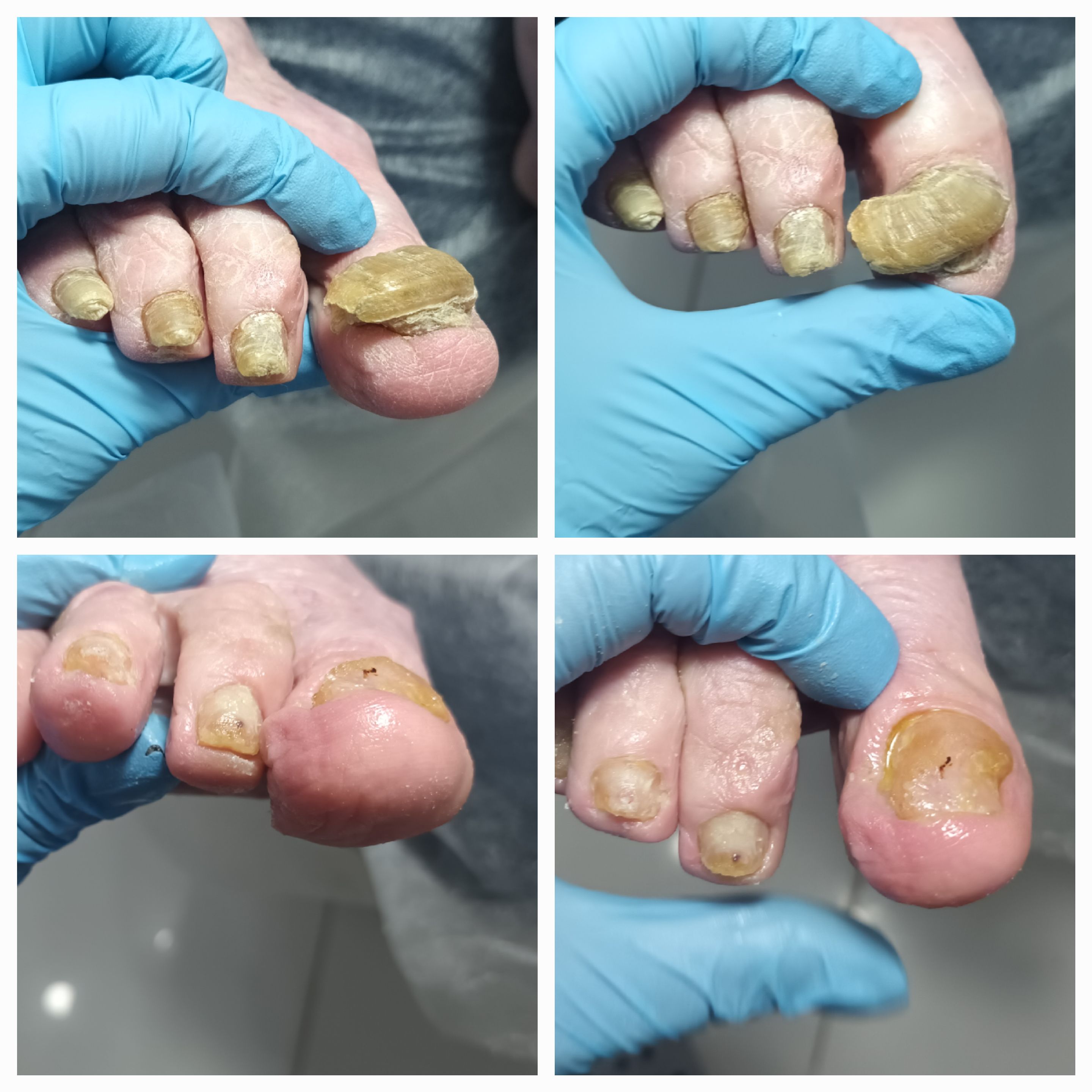 Choroby i defekty płytki paznokciowej - zdjęcie 9