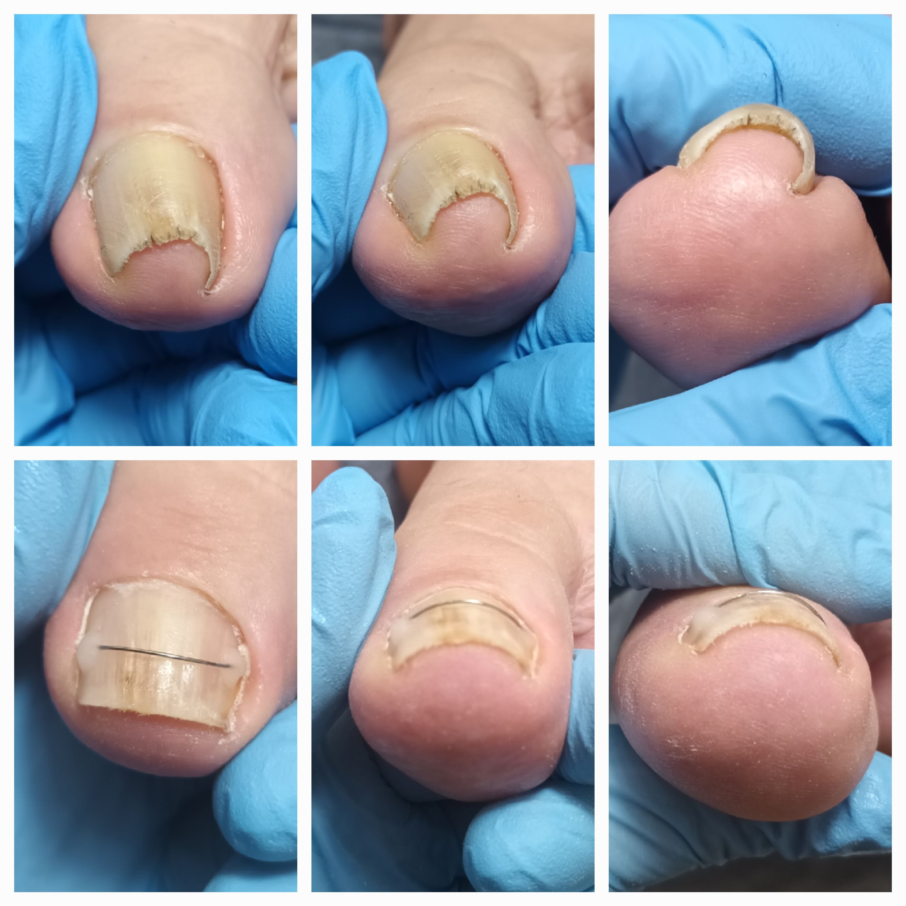 Klamry i rekonstrukcje podologiczne - zdjęcie 9