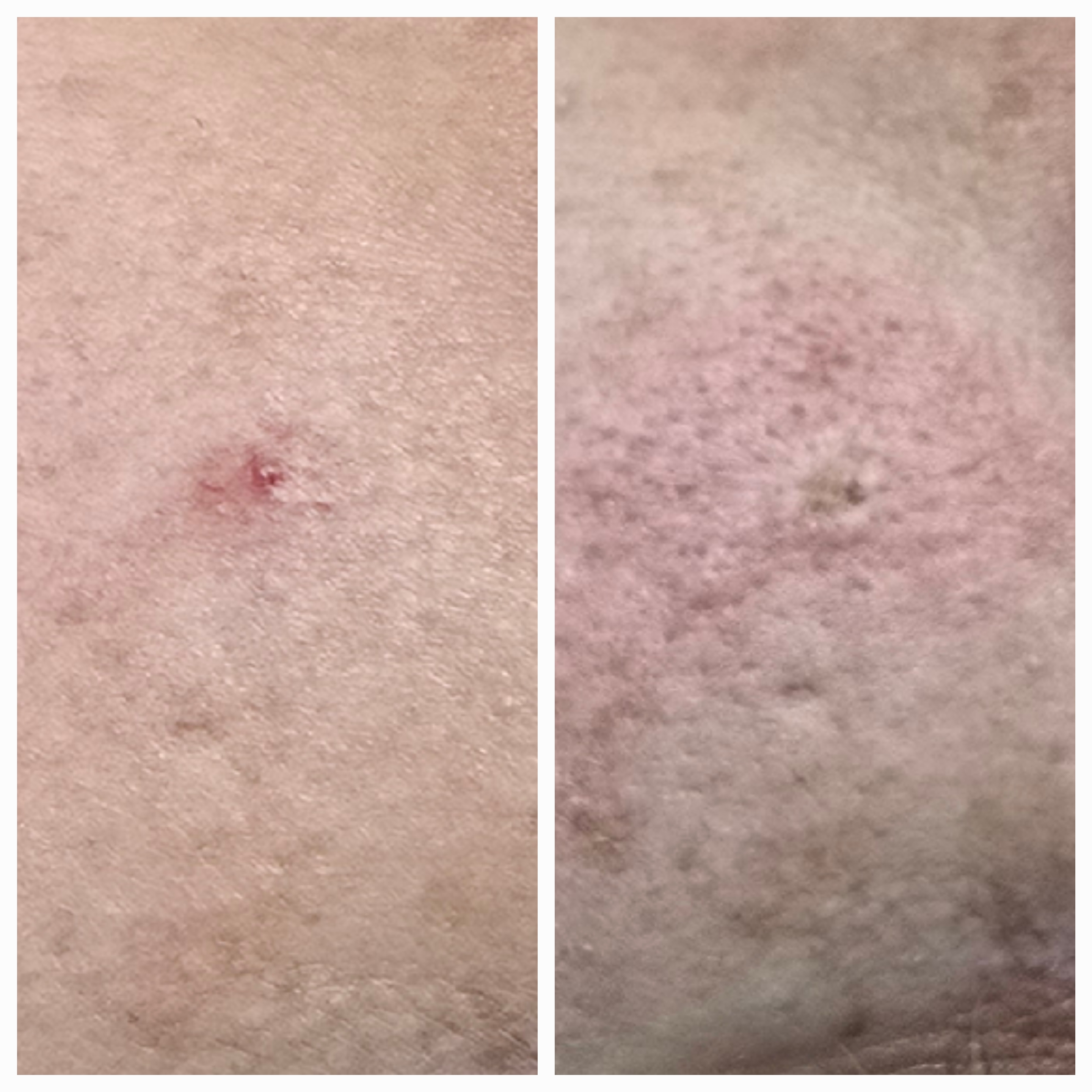 Zamykanie naczynek i usuwanie włókniaków - zdjęcie 9