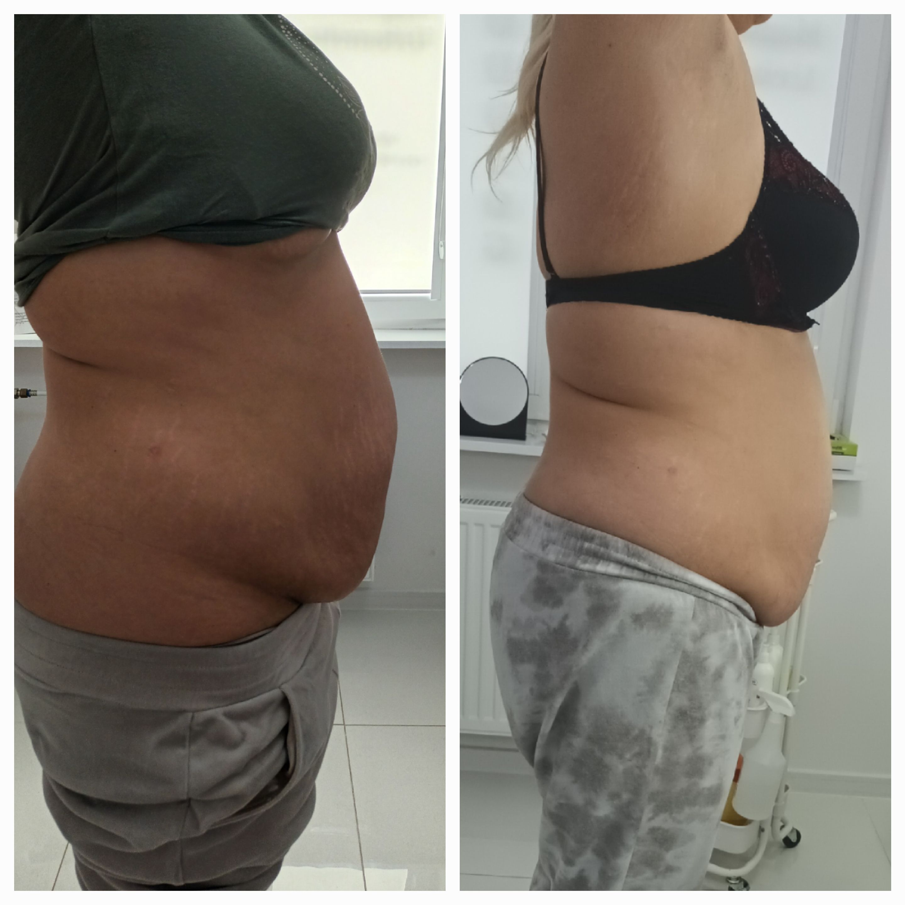 Mezoterapia, lipoliza i stymulatory - zdjęcie 1