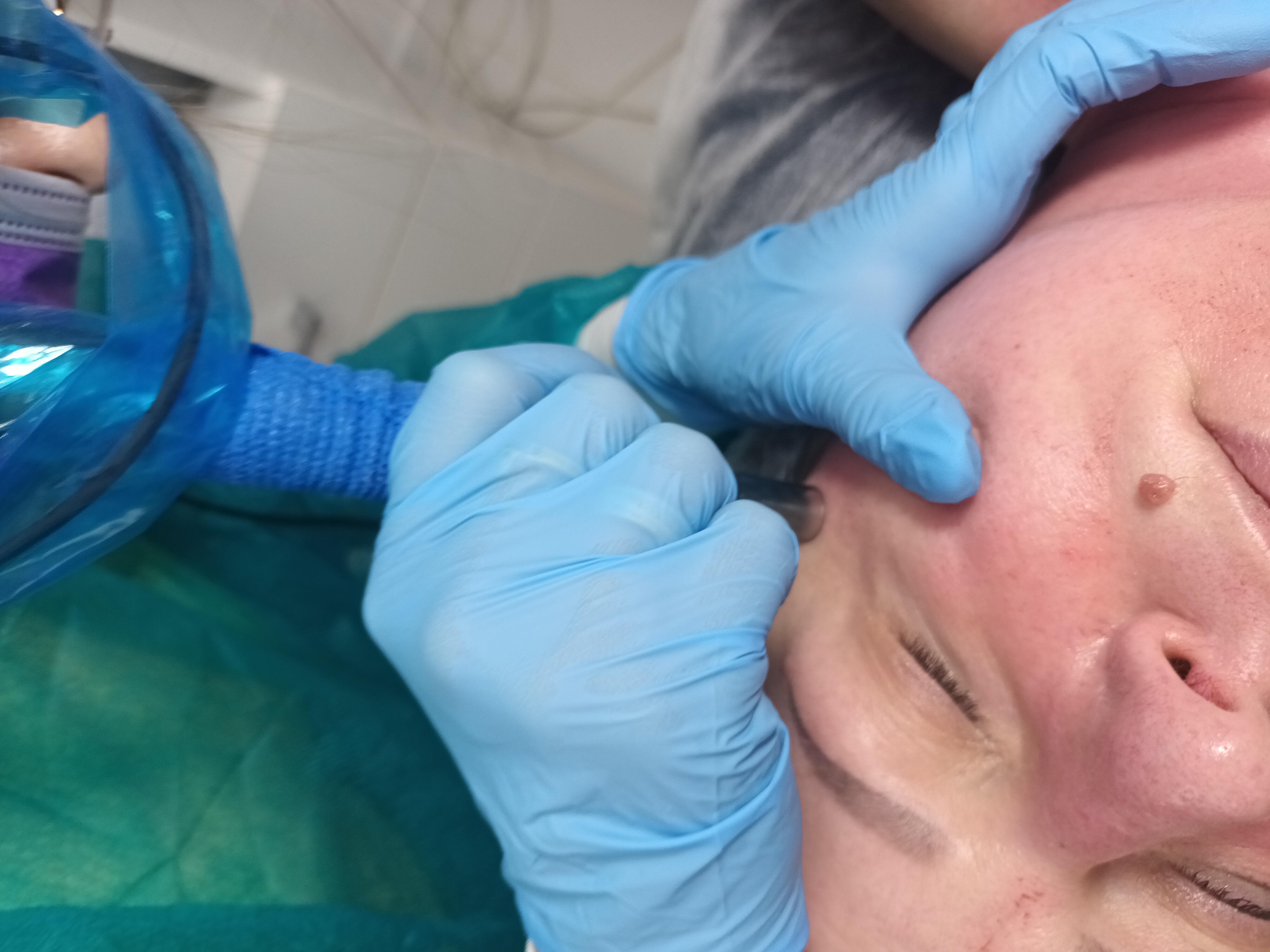 Mezoterapia, lipoliza i stymulatory - zdjęcie 10