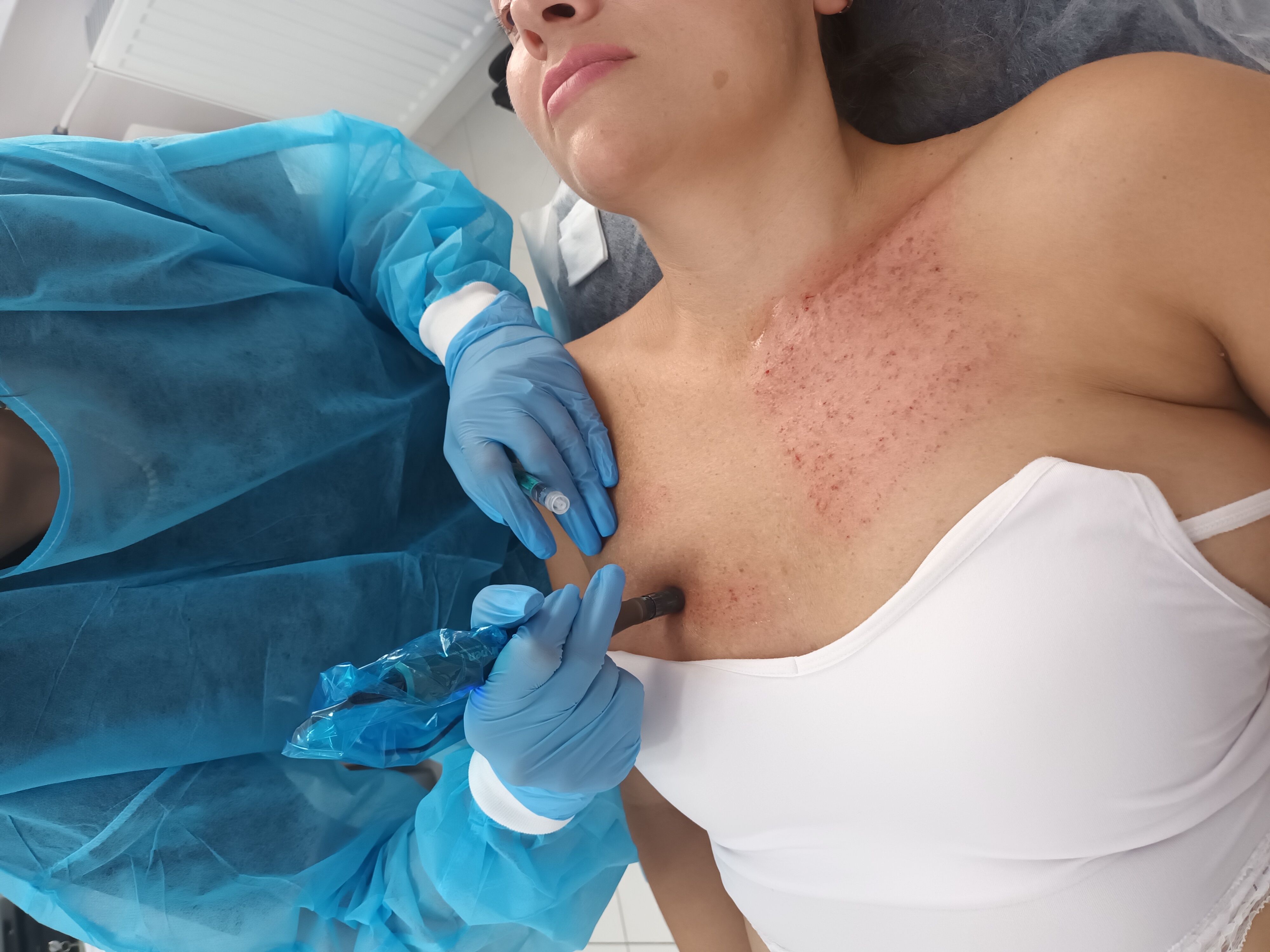 Mezoterapia, lipoliza i stymulatory - zdjęcie 11