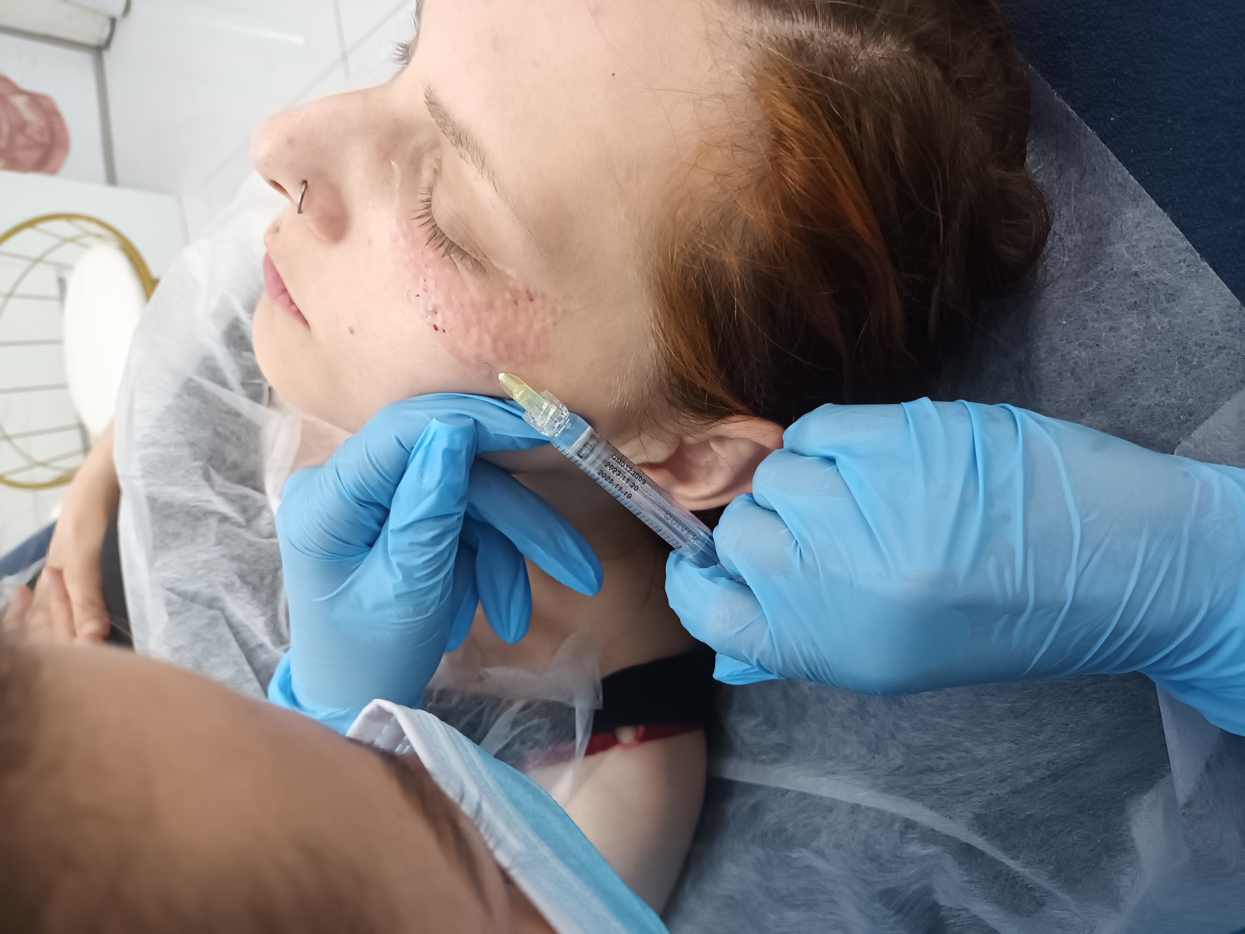 Mezoterapia, lipoliza i stymulatory - zdjęcie 12