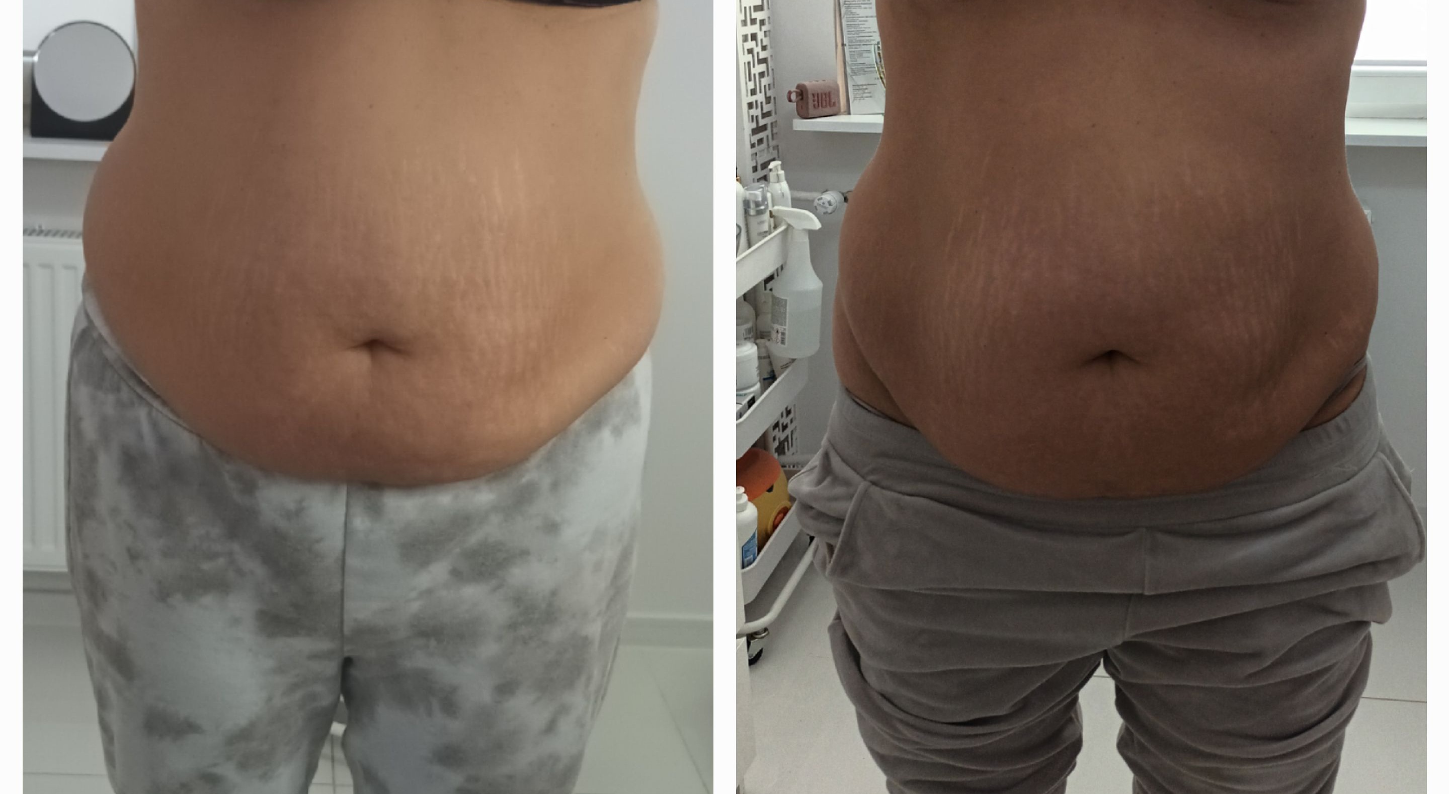 Mezoterapia, lipoliza i stymulatory - zdjęcie 2