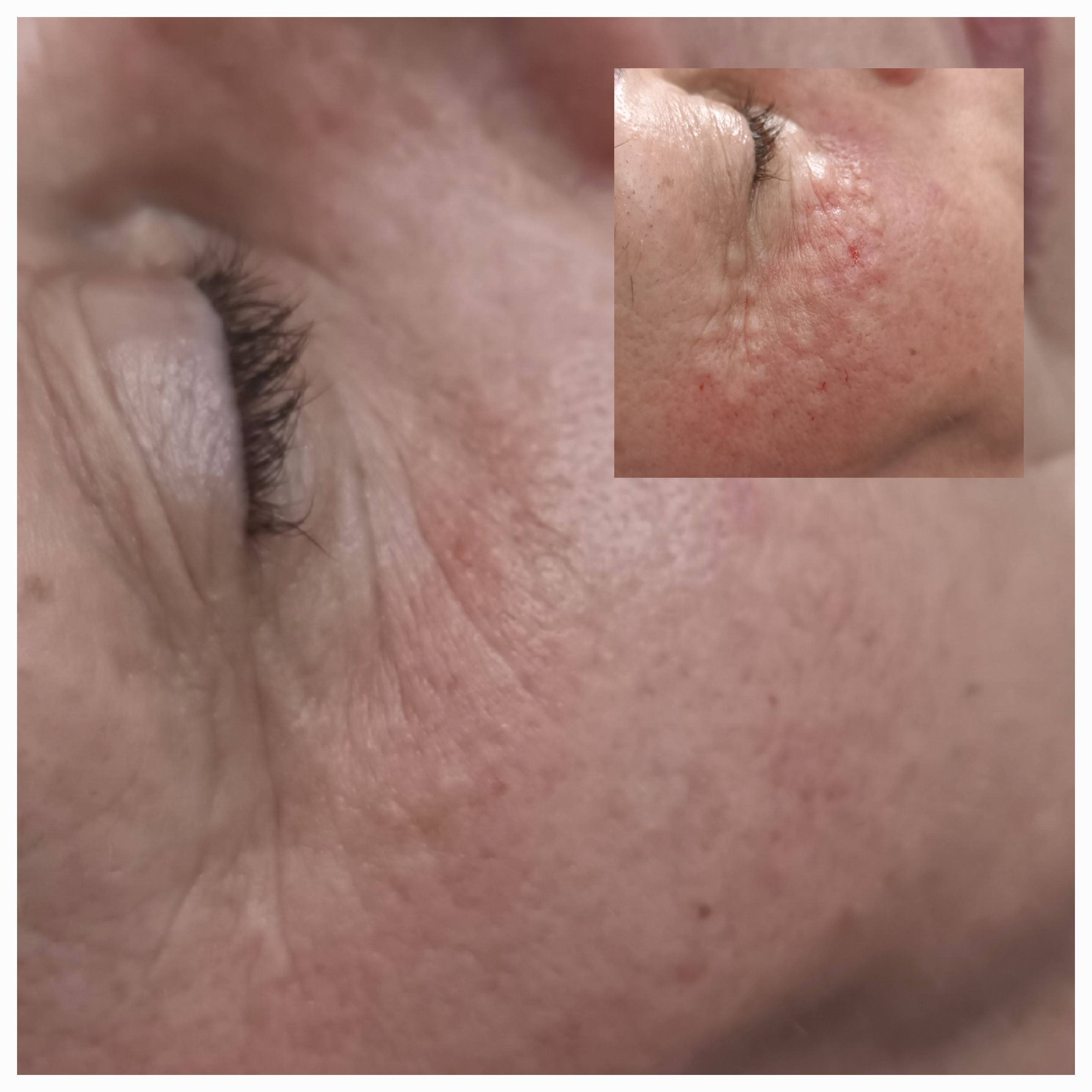 Mezoterapia, lipoliza i stymulatory - zdjęcie 3