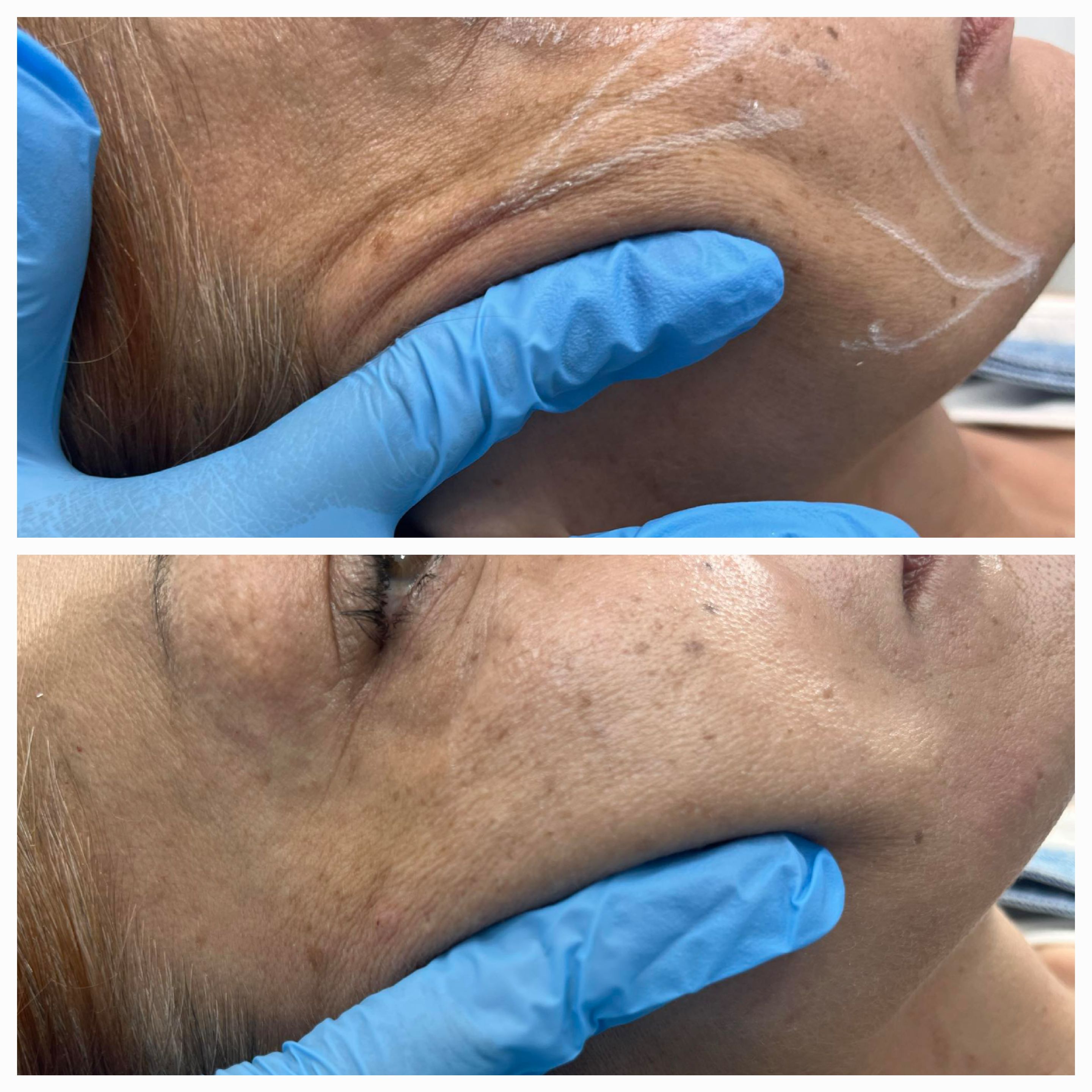 Mezoterapia, lipoliza i stymulatory - zdjęcie 4