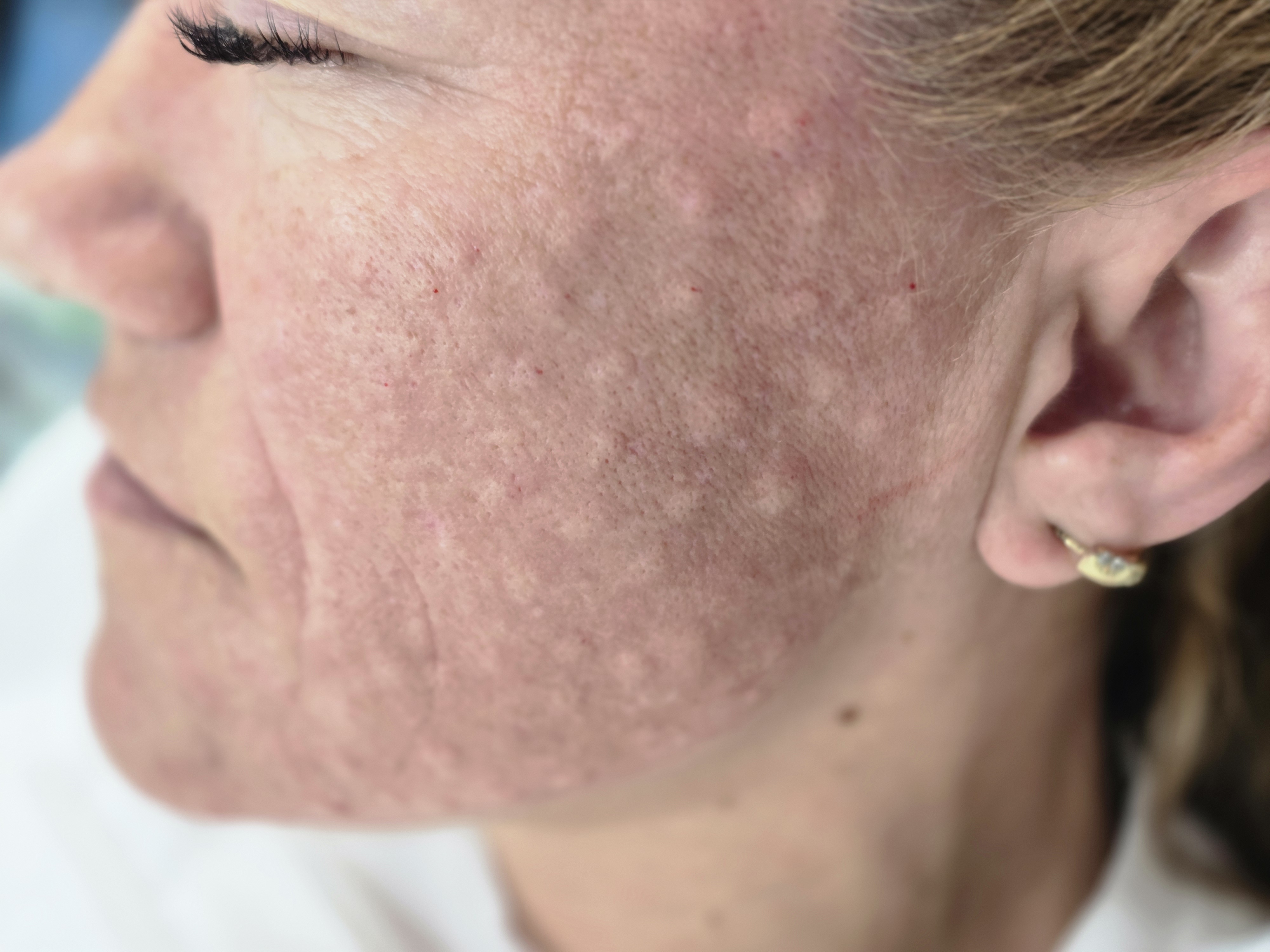 Mezoterapia, lipoliza i stymulatory - zdjęcie 5