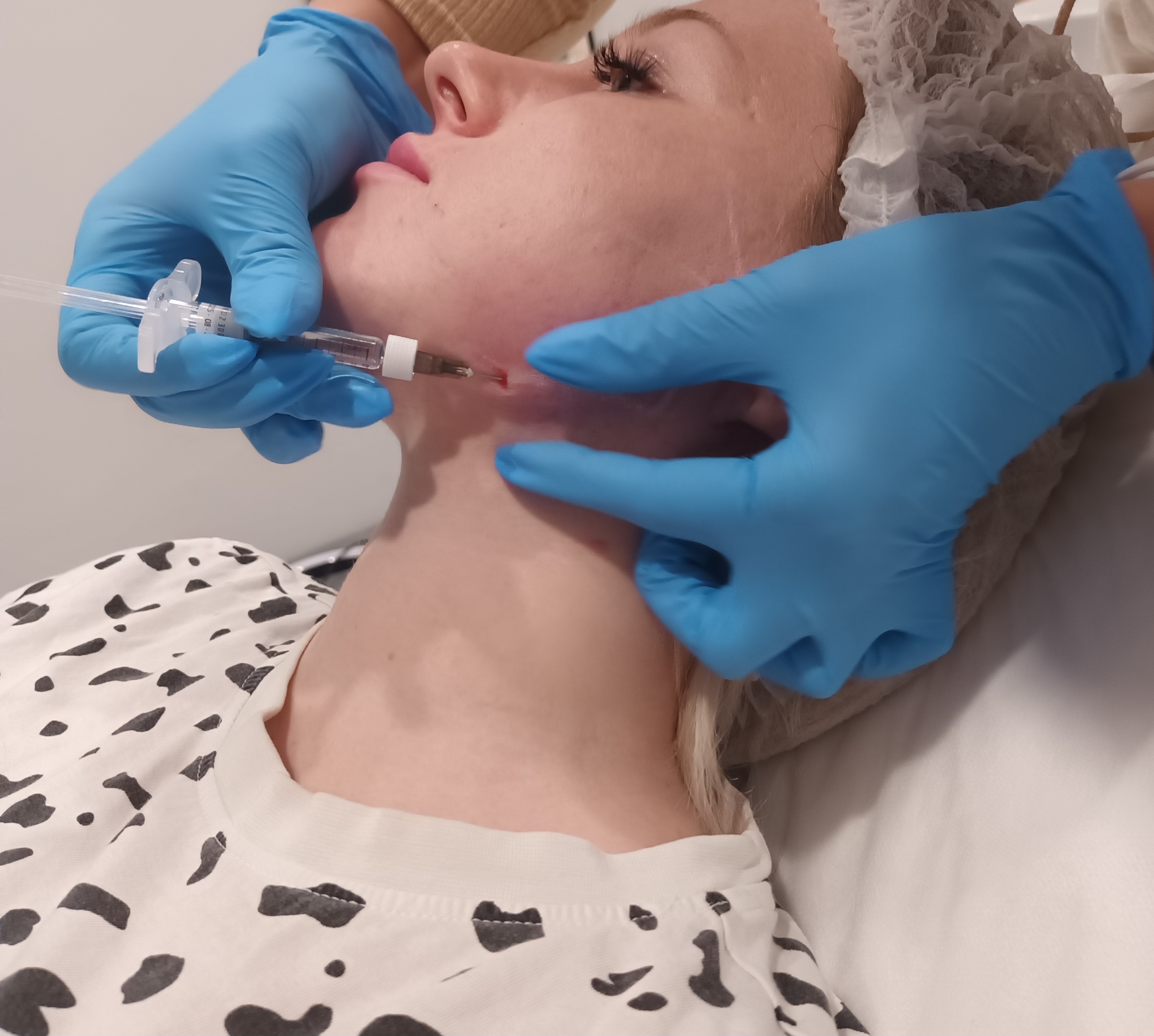 Mezoterapia, lipoliza i stymulatory - zdjęcie 6