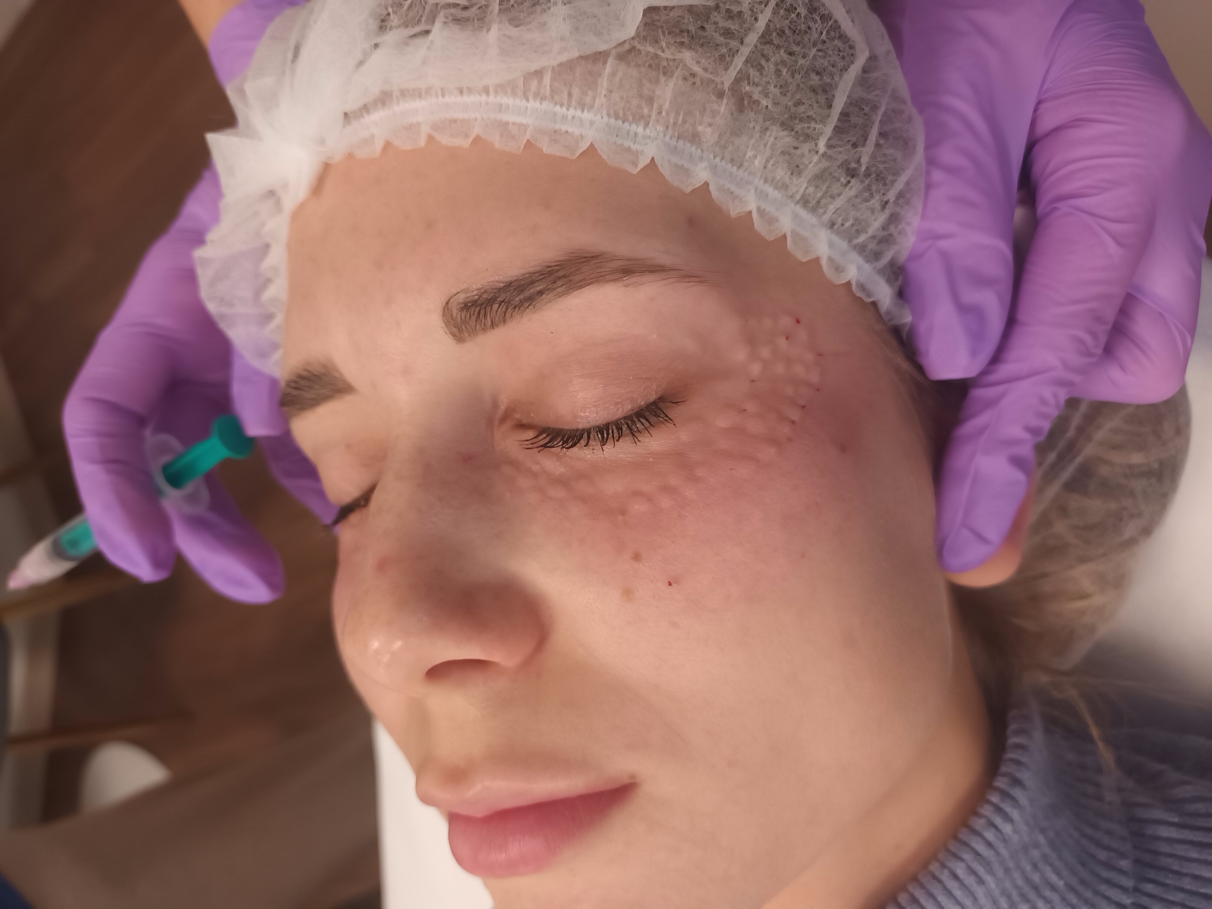 Mezoterapia, lipoliza i stymulatory - zdjęcie 8