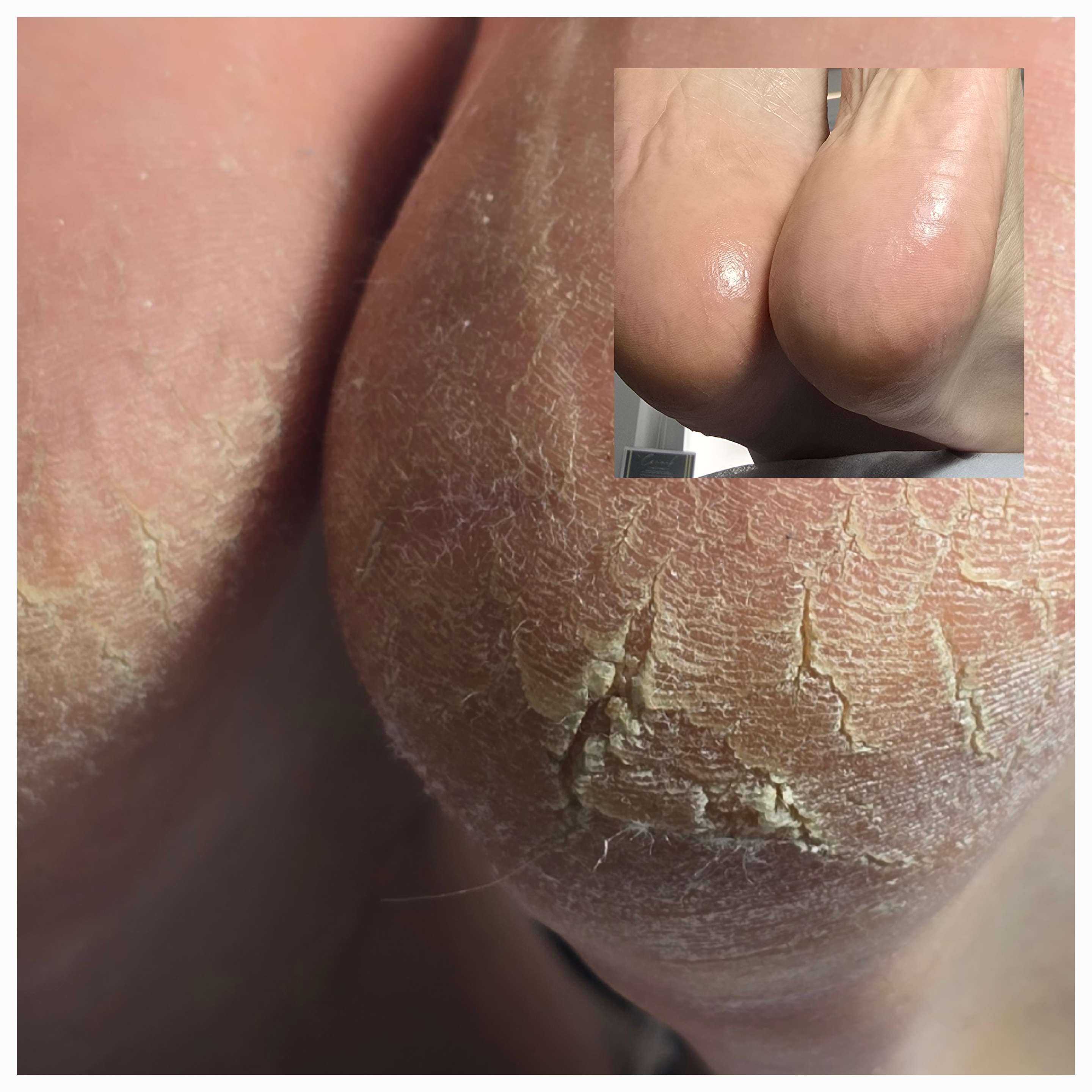 Lecznicze zabiegi podologiczne